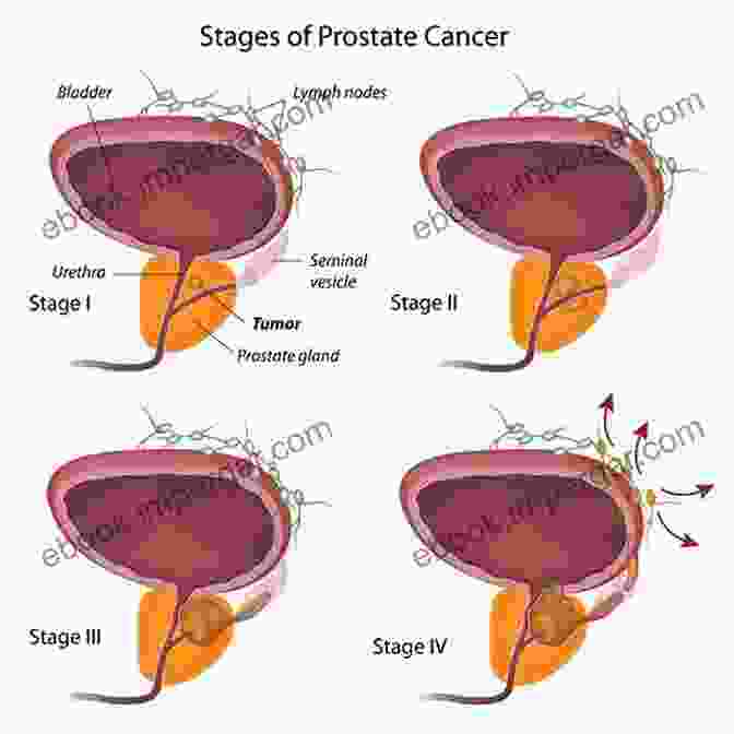 Maintaining A Positive Attitude During Prostate Cancer It S Okay To Have Prostate Cancer: Positive Fun Approach From A Real Men: Aggressive Prostate Cancer Survivor Stories